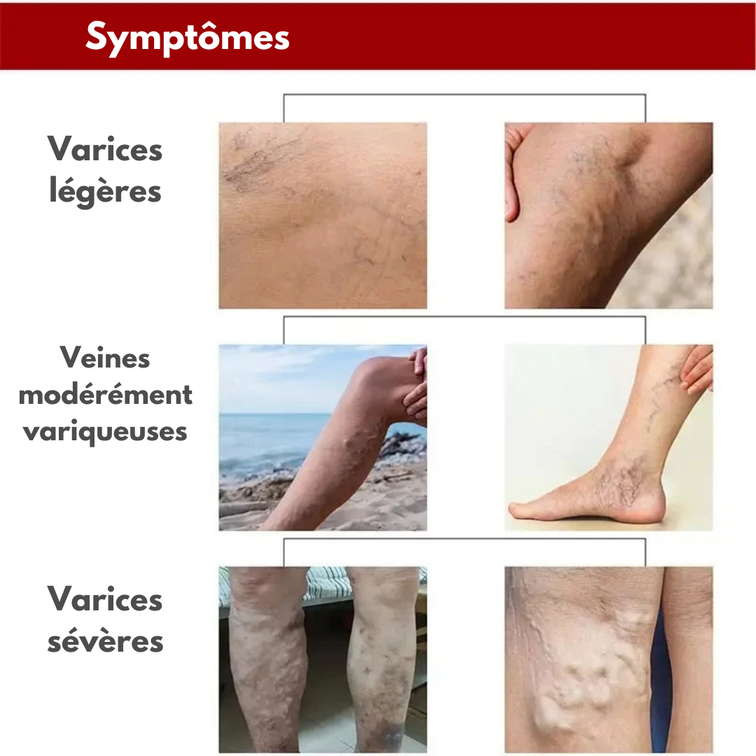 Crème Anti Varice Kanye™ : Restaure les veines endommagé✨